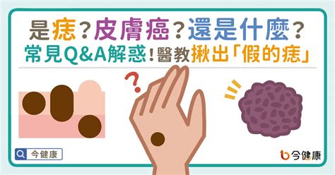 紅色痣代表什麼|是痣？還是皮膚癌？皮膚科醫師教你揪出「假的痣」，。